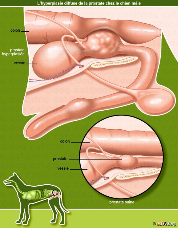 Hyperplasie benigne prostate
